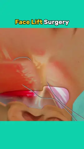 Face Lift Surgery Medical Animation 3D #faceliftsurgery #facelift #plasticsurgery #medicalanimation 