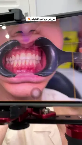 عياده dr.wilsonsmile  عاملين خصومات ل اي حد من عندي ♥️👇 -خصم 50% علي الكشف  - خصم ٢٠٠ جنيه علي الحشو العادي  ٨٠٠ بدل ١٠٠٠ - خصم ٣٠٠ جنيه علي حشو العصب ١٣٠٠ بدل ١٦٠٠ - التبييض ١+١ =١ - خصم ١٥٠ جنيه علي تنظيف الجير ٣٥٠ بدل ٥٠٠ - نظام تقسيط علي الباكيدچات ٥٠% مقدم والباقي علي ٦ شهور - خصم ٣٠٠ جنيه علي تركيبات البورسلين  ١٢٠٠ بدل ١٥٠٠ #bassel_mostafa #foryoupage #fypシ 