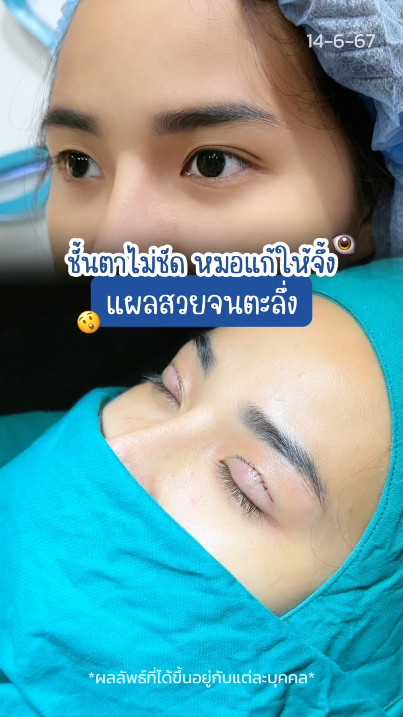 ชั้นตาไม่ชัด หมอ #ทำตาสองชั้น ให้จนจึ้ง!!  #รีวิวตาสองชั้น #skyclinic #ทีมแพทย์หมอสกาย #สกายคลินิก #ศัลยกรรมตา  #รีวิวตาสองชั้นskyclinic #sweeteyes #ทําตาที่ไหนดี #ตาสองชั้น 