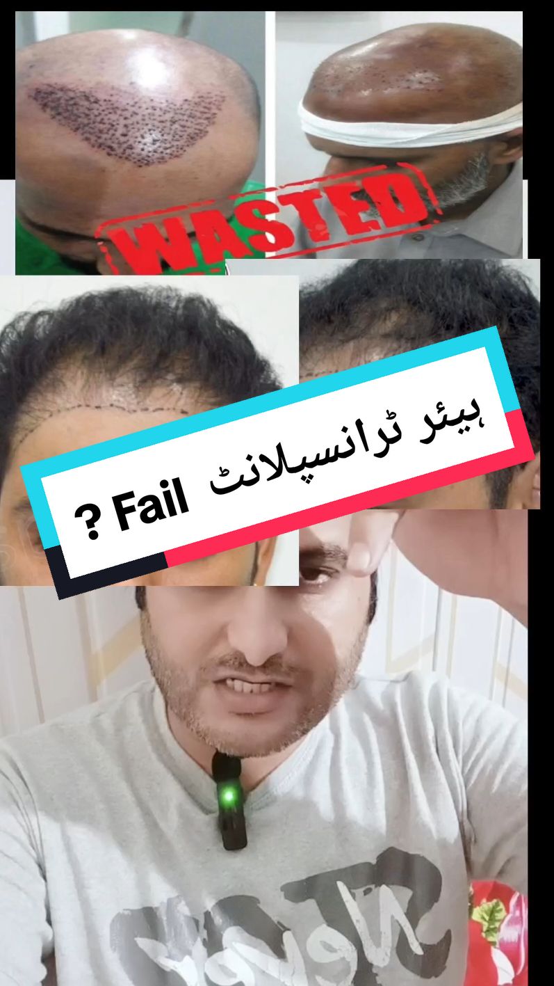 #hairtransplant #hairtransplantturkey #yasirhairtransplant #hairtransplantfail #hairtutorial #for #foryoupage #trending #viral 