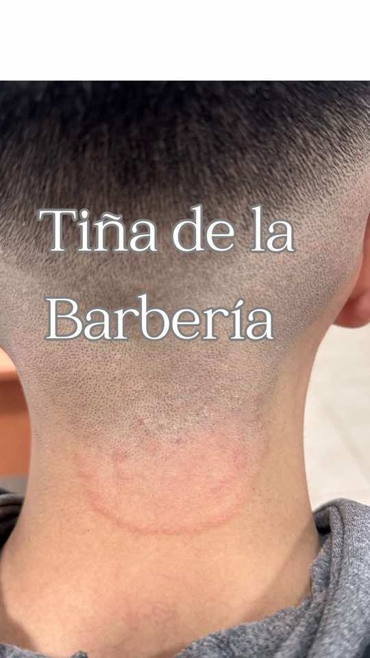 📢Atentis pacientes que fueron a la barbería y les salió un hongo ‼️ No te apliques corticoides!!  El hongo Tricophyton Tonsurans se trata con un medicamento por vía oral, te espero en el consultorio para que lo podamos resolver💫 #tiña #barberia #hongos #peluquería #corticoides #saludybelleza 