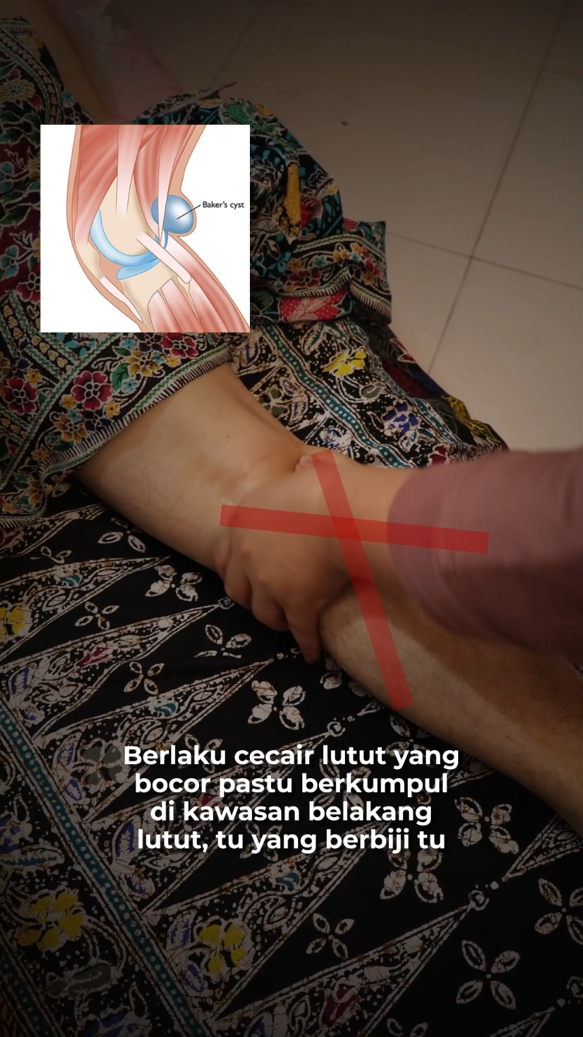 Gel leaking la punca jadi berketul kat belakang pelipat kaki tu. Lama2 nak duduk cangkung, turun naik tangga pun sakit benar bhgn blkg lutut tu.. sampai rasa mcm koyak harmstring. baker cyst ni payah baik tp nak kurangkan tekanan pd lutut tu boleh la buat urutan secara regular #bakercyst #sakitlutut #pelipatlutut 