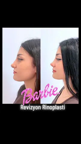 #rhinoplastyturkey#rinoplasti#burunestetigi#rinoplastiizmir#estetik#revizyonburunestettiği#nasenkorrektur#rinoplastika#burunestetiğiizmir#izmir#aydın