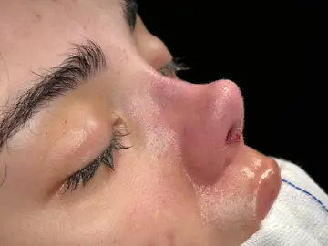 #rhinoplastyturkey#burunestetigi#keşfetteyizzz#keşfet#rinoplasti#rinoplastia#burunestetiğiizmir#estetik#revizyonburunestettiği#tiktok