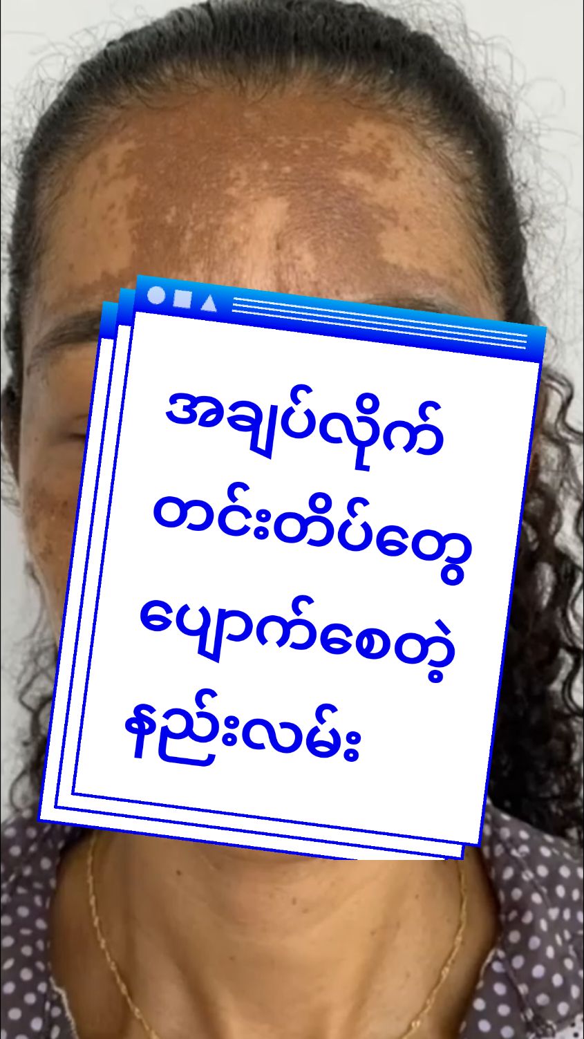 ဘာသုံးသုံးမပျောက်တဲ့တင်းတိပ်အချပ်လိုက်တွေပျောက်တဲ့နည်း#darkspotserum #မျက်နာဖြူဝင်းစေဖို့ #တင်းတိပ်အမဲစက်ပြောက်ချင်သူများအတွက် #ibserum #darkspotserum #ibskincaremyanmar #ပြည်တွင်းပြည်ပပို့ပေးပါတယ် #titokmyanmar #titokmarketing #thinkb4youdo #skincare #madeinkorea #titokmyanmar #1M #mohmoh 