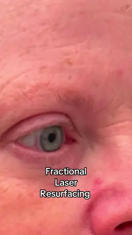 #beforeandafter #laser #laserresurfacing 