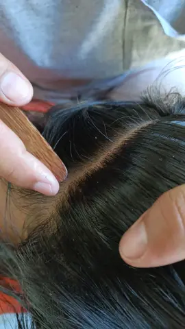 #lice #licetreatment #hair #liceasmr #fyp 