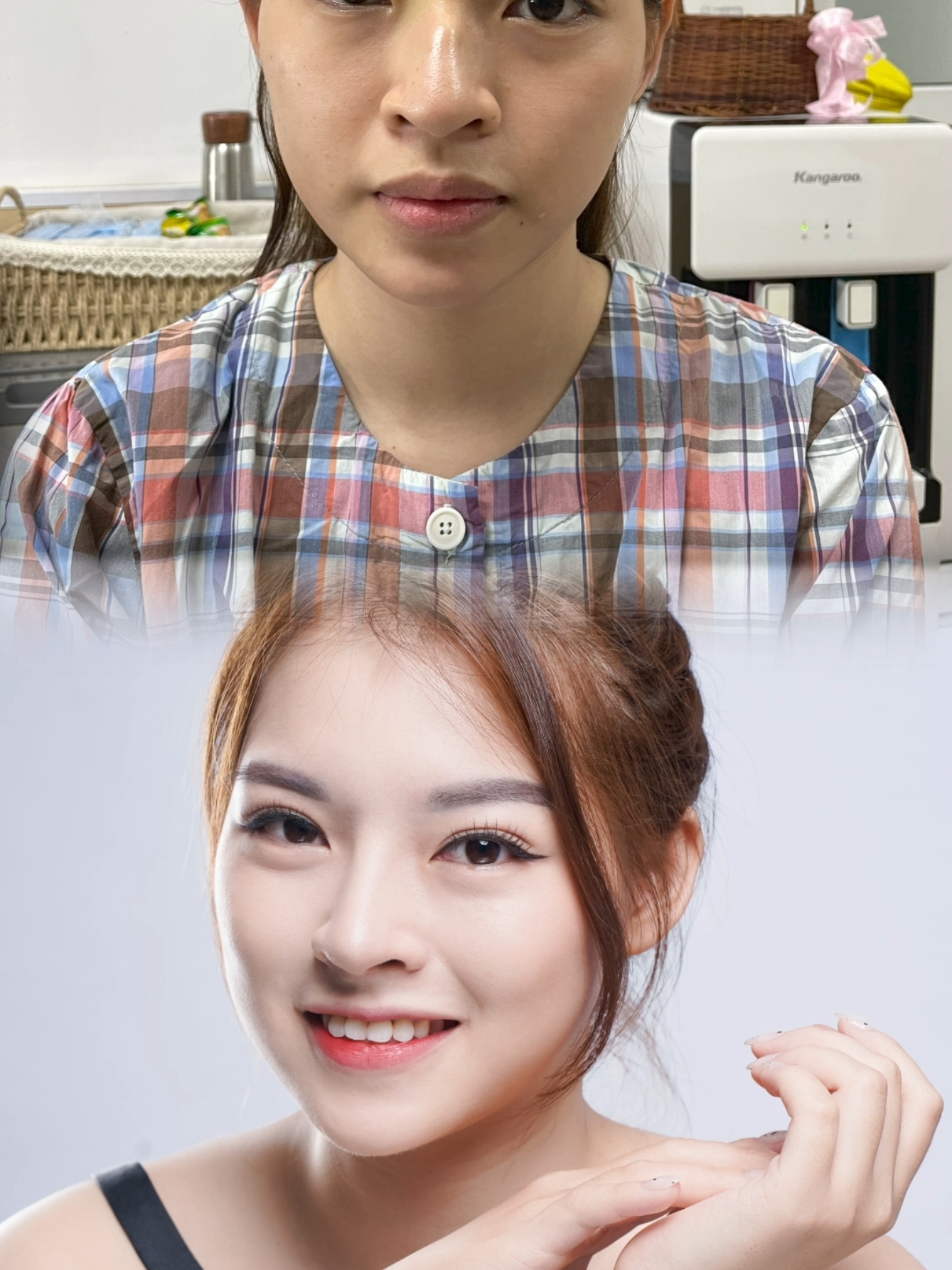 Xử lí mũi gồ cho chị đẹp Quỳnh Anh #nangmuiso1mienbac #tiensithammyTongHai #thammynhuhoa #nangmui 