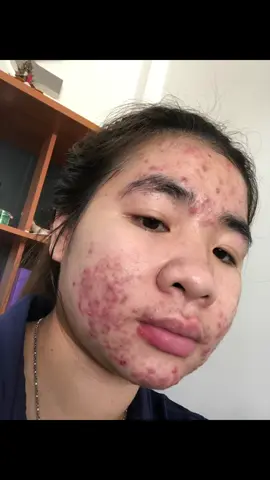 แต้มสิวลูกรัก #dale #acnebuster #acnetreatment #acnesolution   