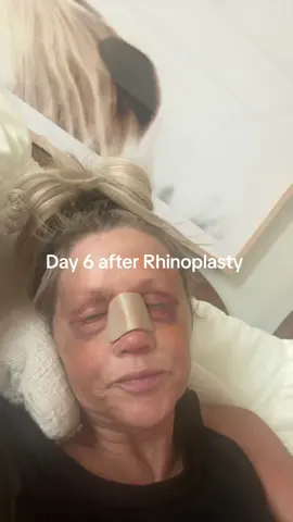#rhinoplasty 
