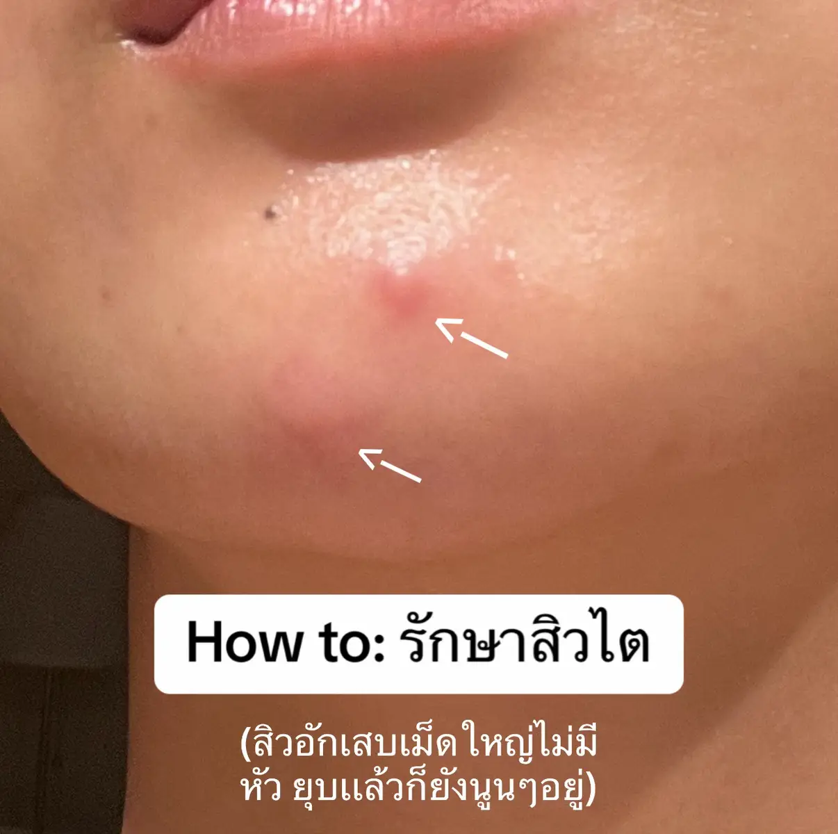 #สิว #สิวอุดตันหัวปิด #สิวอุดตัน #สิวอุดตันหัวดํา #provamed #provamedretinol #เรตินอล #เรตินอลใช้ยังไง #เรตินอลตัวไหนดี #สิวอุดตันฝั่งใน #เรตินอลสูตรอ่อนโยน #สิวอุดตันหาย #สิวอุดตันควรกดออก #หน้าไม่เรียบเนียน #สิวหาย#สิว#สิวอุดตันหัวปิด #สิวอุดตันต้องกดออก