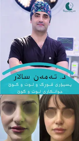 ‎نەشتەرگەری #جوانــکاری_لــوت  ‎العملية #تجــميل_الانــف   @د. تەمەن  سالار 😍😍😍 ‎‏‎دکتۆرا(بۆردی عەرەبی) لە نەشتەرگەری و نەخۆشیەکانی قورگ و  لوت و گوێ / جوانــکاری لــوت و گوێ #foryou #foryoupage #for #girl #کچانە #کچ #کەرکوک #rhinoplasty #عمليات #CapCut #viral #viralvideo #viraltiktok #nose #lwt #jwankary #slemani #hawler #dhok #penjwen #baghdad #iraq #عمليات_تجميل #خشم #👃🏼 #سلێمانی #هەولێر #دهۆک #اکسبلور #explore #hanskz #dla #foryou #pp #fypシ #Sulaimani #ranya #qaladz #soran #koye #rawandz #rhinoplastysurgery #nose #nosejob #erbil #dukan #kirkuk #cosmetics #skincare #skin #plasticsurgerybeforeandafter #beauty #cosmetics #beautychallenge #CapCut 