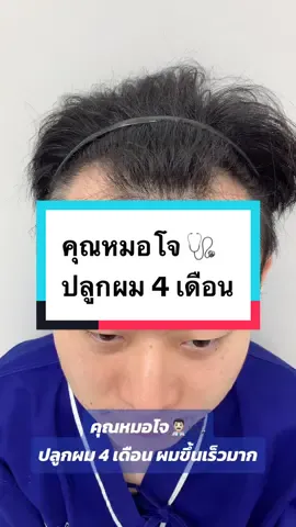 #ปลูกผม #คลินิกปลูกผม#เกศาตัวจริงเรื่องเทคโนโลยี #hairtransplant #NNN #คลาสแฟชั่น 