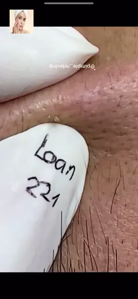 #squeeze #squeezeyuk #acne #pimple #pimplepop #blackhead #satisfying #foryoupage