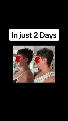 This has me SHOOK!!! how can a 15 minute routine change so much in 2 only days.. HOW!! 🤯   #mysticalpostureroutine #beforeandafter#15minutepostureimprovementroutine #15minutepostureroutine #themysticalpostureroutine #dowagershump #neckhump #posturecorrection #posturehealth #forwardheadtilt #neckpain #neckhumpremoval #neckhumpfix #neckhumpcorrection #posturefix #coreexercise #wideribcage #backpainrelief #backstrength #poorposture #badposture #15minutepostureimprovementroutine #mysticalmckay #mysticalyogimckay #themysticalexperience #doublechin #turkeyneck #forwardheadposture #fhp #fht 
