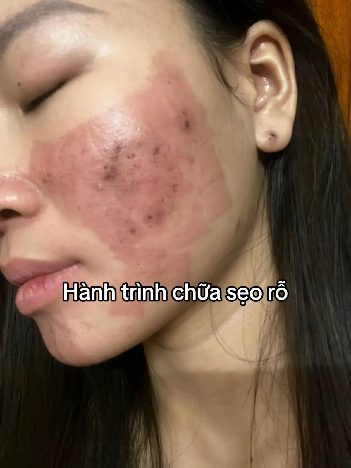#miaclinic #sẹorỗ 