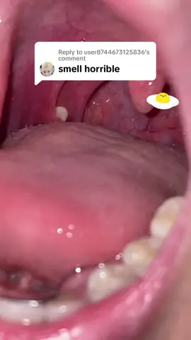 Replying to @user8744673125836  Couldn’t agree more! Tonsil stones smell like sulfur or rotten eggs, and are a common cause of bad breath.  How often are you getting tonsil stones? 