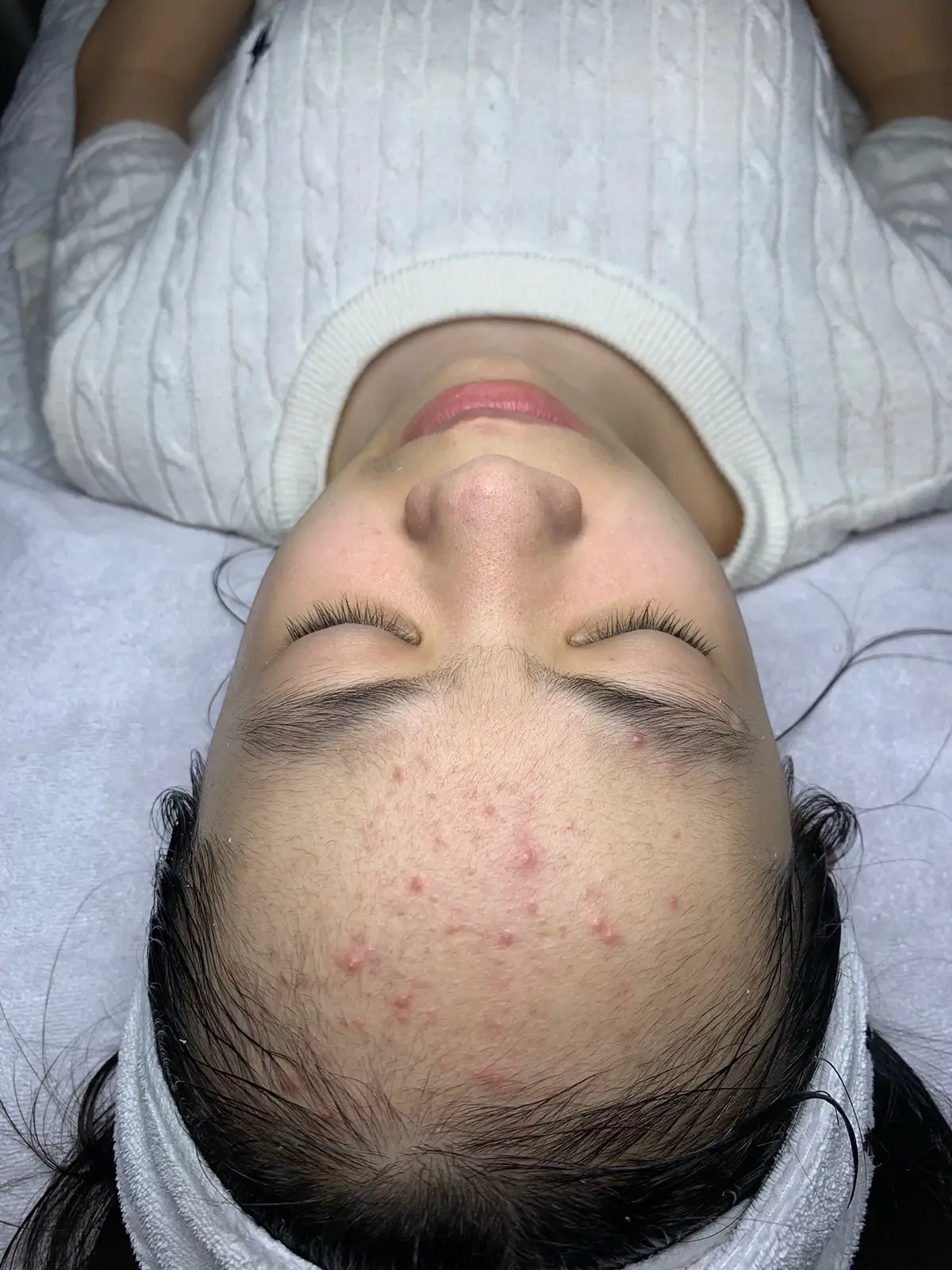 Trộm vía da hết mụn sau 1 buổi Chemical peel ☺️ Sau peel hết mụn các bạn phải duy trì những sản phẩm làm sạch và sản phẩm điều trị mụn để tránh tái mụn nhé 