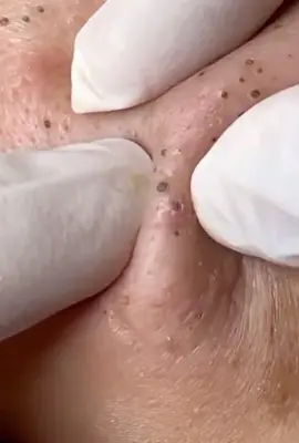 Ủ mụn drmai #Vân_Anh_Trị_Mụn #trimundrmai #trimundrmai #ủ_mụn 
