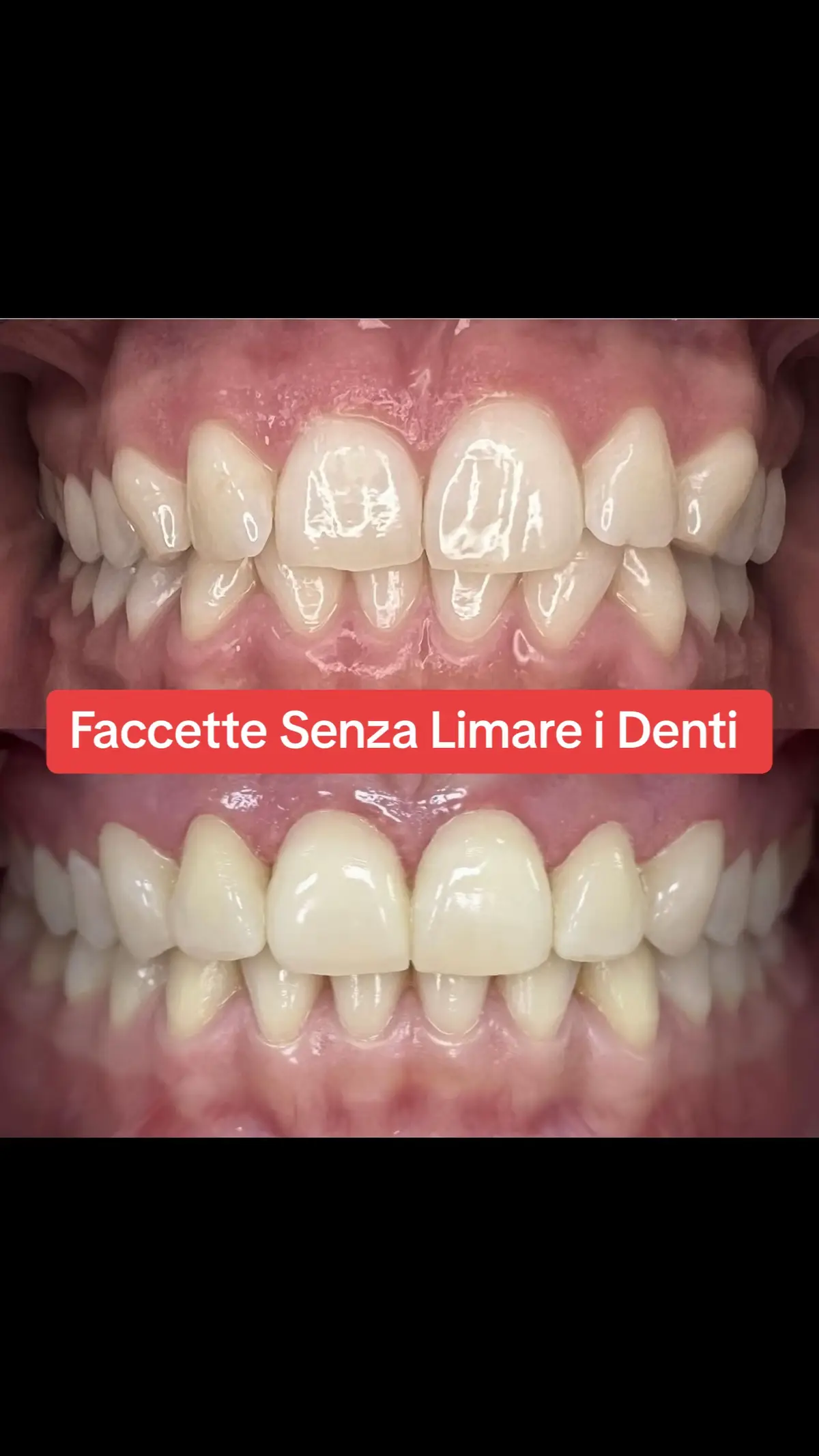 ⚠️Faccette Senza Limare i Denti ⚠️ . . ⚠️ Modifica i tuoi denti in pochissimi minuti ottenendo un risultato estetico eccezionale ⚠️ • . ▪️Prima Visita E Preventivo Gratuito....3489242993 📞 . . . . #StudioDeStefano #aesthetics #dentistry #Smile #esteticdentistry #estetica #medicinaestetica #belezza #beauty #wellness #benessere #sorrideresempre #smile #sorriso #smilealways #sbiancamentodentale #dental #dentaldesign #dentalphotography #dentalclinic #holisticdentistry #holisticdental #dentalsparkesthetics#perte 