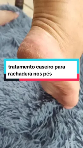 tratamento caseiro para rachadura #receitasnaturais #benefícios #remediocaseiro 