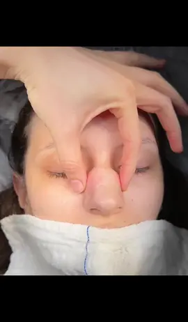 Rhinoplasty🔥 . . . . . #rinoplasti#nasenkorekturtürkei#nasenkorrktur#rinoplastika#rhinoplasty#burunestetigi#burun#estetik#güzellik#burunameliyatı#estetikburun#revizyonburun#revizyonrinoplasti#revisionrhinoplasty 