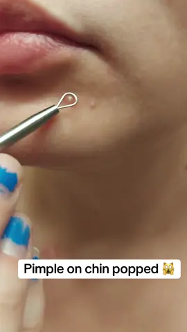 Pimple on chin removed #satisfyingvideo #popping #skincare #beauty 