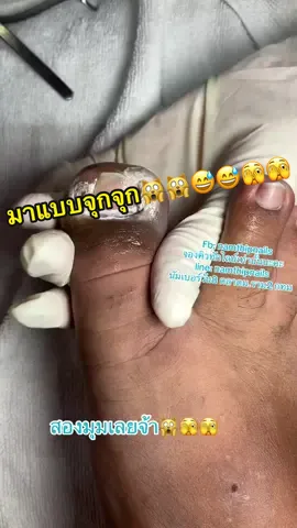 💓 #namthipnails #ตัดเล็บขบ #ตัดหนัง #ทำเล็บ #ร้านตัดเล็บขบ #ร้านตัดเล็บขบราม2 #ร้านทําเล็บ #เล็บขบ  #เล็บเชื้อรา Fb : namthipnails  Line : @namthipnails  นัมเบอร์วัน8 ตลาดม.ราม2  กทม  Map: namthipnails  https://goo.gl/maps/JmwpCKLfKwmhKGK96  ร้านเปิดทุกวัน เวลา12.00น-22.00น.
