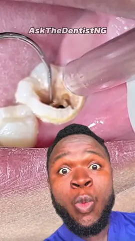 This is what happens when you have this kind of hole on your tooth! Pls Share Widely  #oralhealth #oralhygiene #toothdecay #toothinfection #toothachepain #dentalcare #oralcare #dentalhygienemonth 
