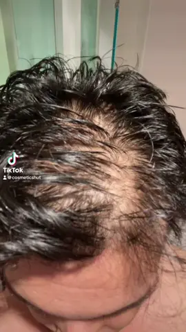 Check out my hairloss journey on my TikTok page. #hairloss #minoxidil #hairgrowth 