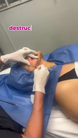 Rejuvenecimiento facial con endolift🙌🏼 este tratamiento consuste en la destruccion de grasa en zona mandibular o de jowls #medicinaestetica #otorrinogdl #gdl #medicosgdl #rejuvenecimiento #otorrinolaringologia #flacidez #endolift 