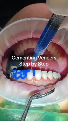 Cementing veneers step by step. #veneerprocess 