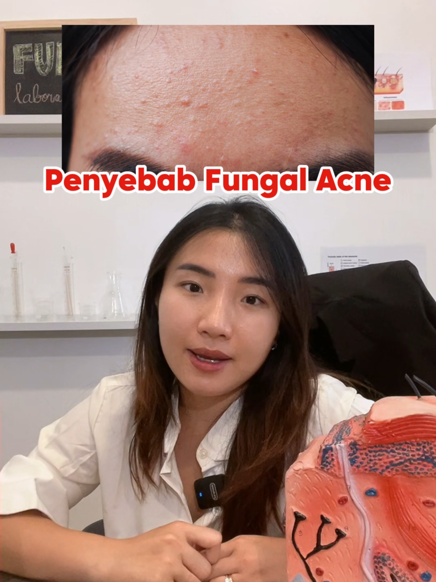 penyebab terjadinya fungal acne! #funskincare #fungalacne