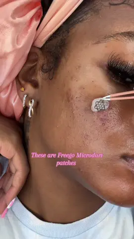 Love microdart patches #skintok #pimplepatchremoval 