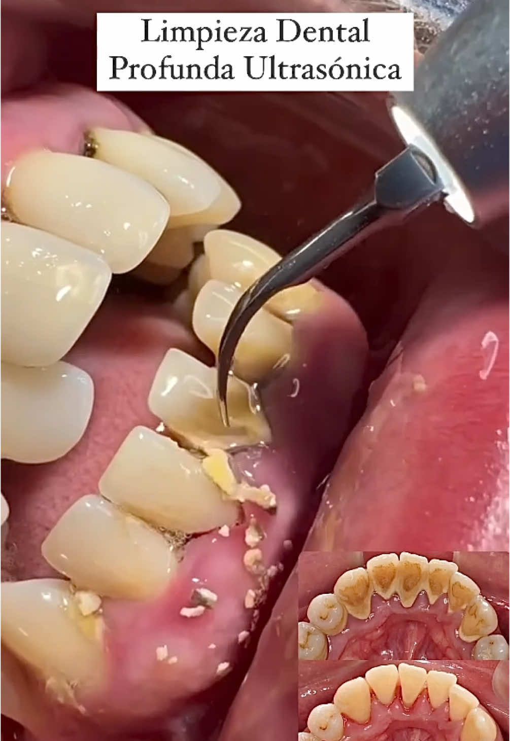 ✅ LIMPIEZA DENTAL PROFUNDA ULTRASÓNICA 🦷 - PIURA La limpieza dental es un procedimiento mediante el cual se elimina la placa y el sarro que se forma en la boca. Estos son productos de la acumulación de bacterias y una higiene inadecuada. Por estos motivos es necesario realizarse una limpieza dental profesional cada 6 meses. Esta debe complementarse con una rutina adecuada de higiene en casa. 📌 Informes: Wpp 966 929 076 #piura #piuraperu #piuratiktok #piurana #piurano #piupiu #piuraperú #piuranadecorazon🥰💕🌻 #dientes #dentist #odontologia #limpiezadental #limpiezadentalprofunda #limpiezadentalultrasonica #limpiezadentalprofesional #sarro #fyp #fypシ #fypage #fyppppppppppppppppppppppp #sullana #paita #profilaxisdental 