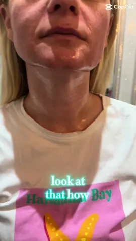 Open pores need corrected? Then you are in the right place at the right time. Hi im Janine Currie and i transform your skin in my 2 clinics . One in Holywood in Belfast and my other clinic is based in Ballyclare! Does your skin need a transformation? Get your free consultation on 07468694308 booked for a day and time that suits you #nonsurgicaltreatment #acnescarringtreatment #skincaretips #stimulatecollagen #facelift #bridalskinprep #skintransformation 