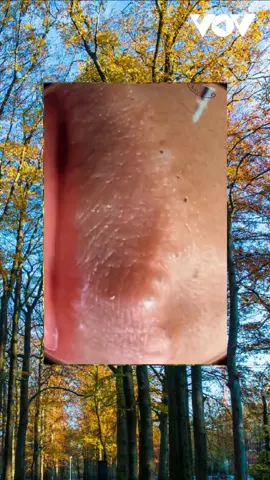 #squeeze #squeezeyuk #acne #pimple #pimplepop #blackhead #satisfying #foryoupage