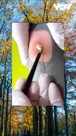 #squeeze #squeezeyuk #acne #pimple #pimplepop #blackhead #satisfying #foryoupage