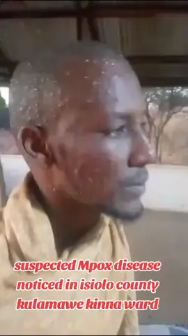 Isiolo County  Garbatulla Sub county  Kinna Ward  Kulamawe location  30/8/2024 1920HRS RE: SUSPECTED MPOX OUTBREAK  Area chief has reported that one Guyo Wagura Guyo, a male adult operating a barber shop within Kulamawe trading centre has developed some signs of the recently reported Mpox disease. #ministryofhealthkenya  #mpoxsensitization 