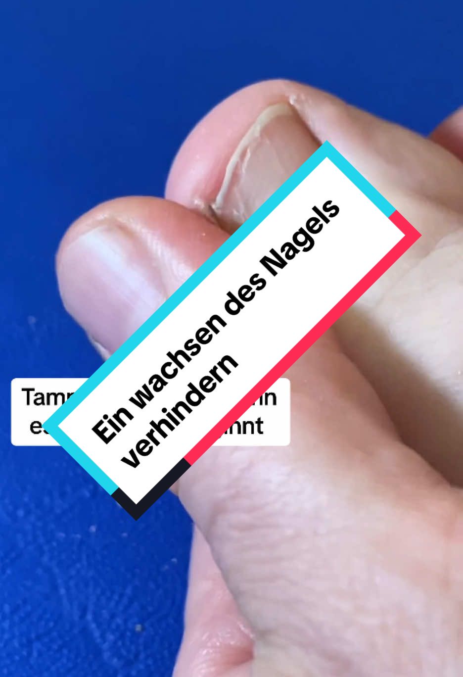So verhindert ihr das ein wachsen der Zehennägel, sobald es drückt eine Tamponade legen, und alles ist wieder fein . #t#tamponadee#eingewachsenernagele#eingewachsenerzehnagelp#podologief#fußpflege