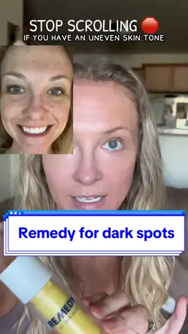 I’m forever thankful for this! Remedy for Dark Spots helps reduce the look of existing dark spots + helps prevent future discoloration. My experience has been nothing but phenomenal. I also feel like its helped with texture because my makeup goes on so much smoother now! @Remedy Science #darkspots #remedy #healthyskin #skincarewithme #makeuphacks #resultsmayvary #laborday #falldealsforyou #creatorsearchinsights 