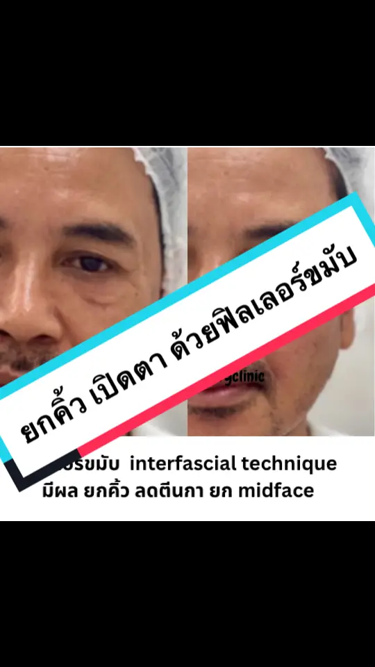 #ฟิลเลอร์ขมับ #ฟิลเลอร์ยกหน้า #ฟิลเลอร์ยกหน้าหมอออย #ฟิลเลอร์ขมับเทคนิคยกคิ้ว #dewyclinic 