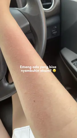 bye kulit kering gatel2 🫶🏻😅 #BekasLuka #HydratingLotion #Jevarine  @By Jevarine 