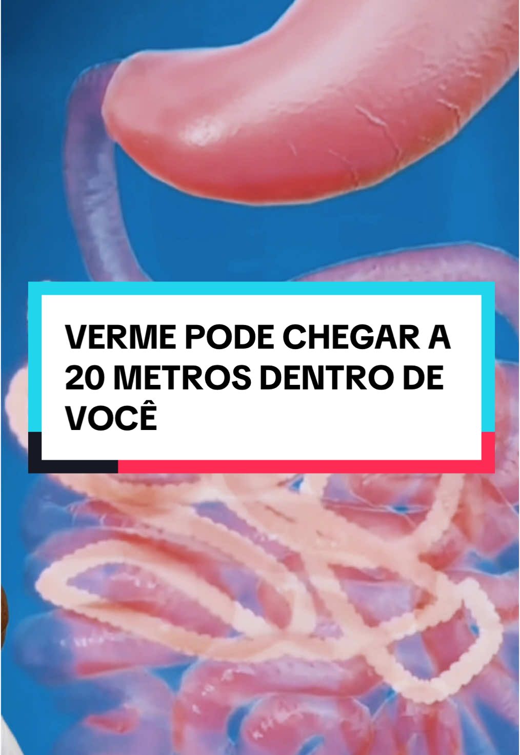 VEJA COMO NÃO PEGAR TENIASE! 🥺👇 🪱🌟 A Teníase é uma infecção intestinal causada por vermes da família Taenia, como a Taenia solium e a Taenia saginata. Esses parasitas são conhecidos por se alojarem no intestino e crescerem bastante!  🤢🩺 Como você pode pegar a Teníase?  Você pode se infectar ao comer carne mal passada ou crua de bovinos (T. saginata) ou suínos (T. solium). Essas carnes podem conter larvas chamadas cisticercos. Após a ingestão, os cisticercos chegam ao intestino, onde os vermes adultos se fixam e começam a crescer, absorvendo os nutrientes que deveriam ser seus. 🍖🚫 🚨🔍 Sintomas da Teníase:  Nem sempre dá sinais, mas fique atento a: - Alterações no apetite 🍽️ - Dores abdominais 🤕 - Diarreia ou constipação 💩 - Perda de peso 🏋️ - Tontura e fraqueza 🌪️ - Irritabilidade e cansaço 😩 - Náusea e vômitos 🤢 💊🩺 Tratamento da Teníase: Se suspeitar de Teníase, procure um médico! O tratamento é eficaz e normalmente inclui remédios antiparasitários. Eles vão ajudar a eliminar os parasitas e restaurar sua saúde intestinal. 🌿 Cuide da sua saúde! E se você teve alguma experiência com isso, compartilhe nos comentários! 💬👇 E claro, COMPARTILHE PARA MAIS PESSOAS CONHECEREM! #PrisãoDeVentre #Constipação #SaúdeIntestinal #DicasDeSaude #DicasDeSaúde #prisaodeventre #tudosobreintestino #intestino #intestinopreso #refluxo #refluxogastroesofagico #gastrite
