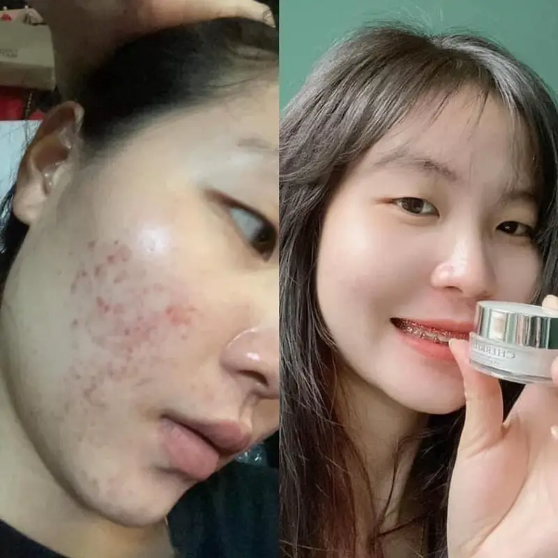 Giảm mụn Trắng da Mờ thâm#trimun #sẵn #trắng #tiktok #Xàphòngserum #cherrithanightcream #thailand 