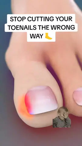 Ever had painful ingrown toenails? It might be because you’re cutting them the wrong way! Avoid cutting your toenails too short or rounding the edges; this can cause the nail to grow into the skin. Always trim them straight across and use proper nail clippers. And remember, cutting toenails when they’re dry helps prevent tearing. If you notice any redness, swelling, or pain, it might be time to see a doctor. Keep your feet happy—cut your toenails the right way #ingrowntoenails​ #toenailcare​ #nailhealth​ #toenailtrimming​ #footcare​ #nailcaretips​ #healthyfeet​ #foothealth​ #viralvideo #shorts 
