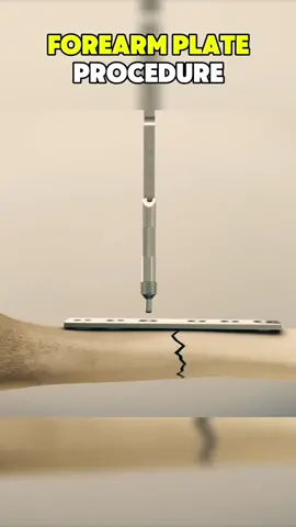 Forearm plate procedure #forearms #forearm #plate #bone #bonefracture #fracture #procedure #recovery #bones 