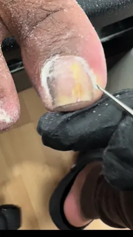 Toe cheese removal #pedi #pedicure #pedicureseason #fyp #foottech #pedicurist #londonpedi #londonpedicure #toecheese #toecheeseremoval 