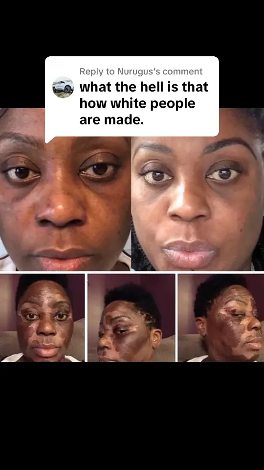 Replying to @Nurugus thanks be to God, irrespective of our skin colour, from light to dark He put us all together in the same way 🙏. Our peel is safe on all skin types and tones 🥰 Elaine Brennan Skin Renewal Peeling #skinpeel #beauty #microneedling  #chemicalpeel #glowingskin #skincareroutine #aesthetics #acne #dermaplaning #antiaging #healthyskin #skincareaddict #skincarelover #facialskincare #correctiveskincare #skinproblem #skincareproducts #facecare #faceroutine #acnefree #aginginreverse #nightskincare #skinrejuvenation #stayglowing #acnetreatment #pigmentation #glow #skintreatment #antiageing #skinclinic #collagen #skinpeels #antiwrinkle #facialtreatment #elainebrennanskinpeel #elainebrennanskinrenewalpeel #collagen #edenvale #greenstonehill #modderfontein#fyp #trendingvids #numberone