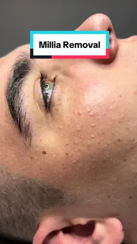 ✨ Millia Removal at Kolaine Beauty Lounge ✨ Today, we carried out an advanced electrolysis treatment to safely and effectively remove millia – those tiny white bumps that can appear on the skin. 🙌 This technique uses precise electrolysis to gently remove the milia without damaging the surrounding skin, leaving you with a smoother, clearer complexion. If you’ve been struggling with millia, Kolaine Beauty Lounge offers expert care to help you achieve the skin you deserve! 💖 Book your consultation today and let’s get your glow on! 💆‍♀️✨  #MilliaRemoval #Electrolysis #KolaineBeautyLounge #SkincareTreatment #GlowingSkin #BeautyTreatment #ClearSkin